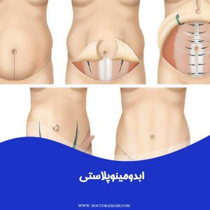 ابدومینوپلاستی