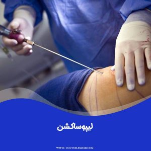 لیپوساکشن