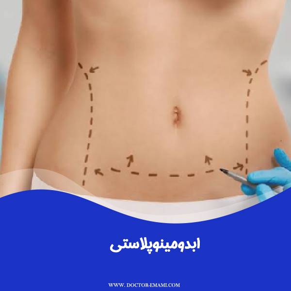 ابدومینوپلاستی