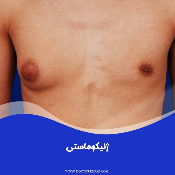 ژنیکوماستی