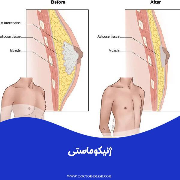 ژنیکوماستی