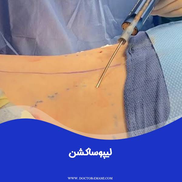لیپوساکشن